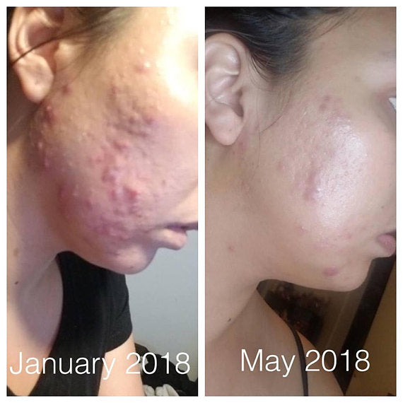 Skincare Acne Treatment