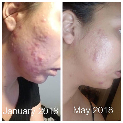 Skincare Acne Treatment